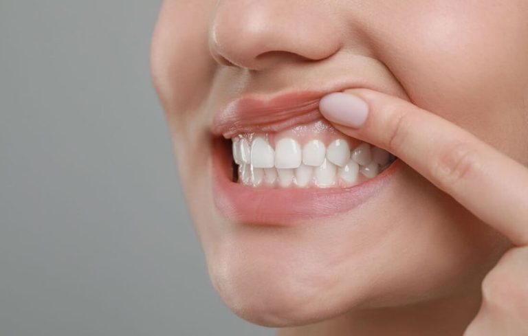 En qué consiste la periodontitis crónica DentalQuality