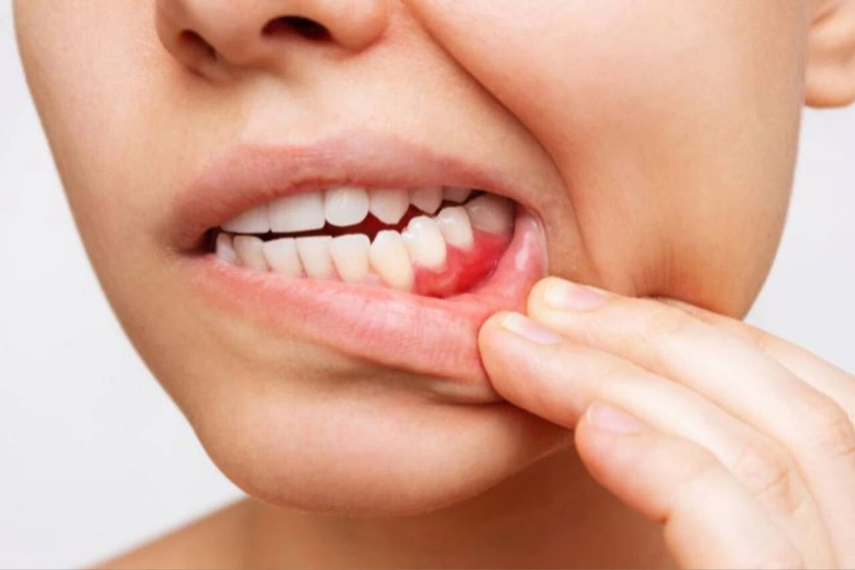Diferencias entre gingivitis y periodontitis