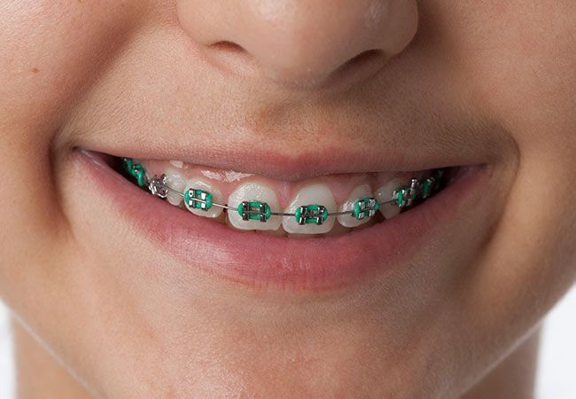 mitos de la ortodoncia