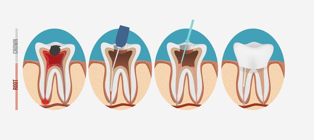 fases endodoncia dental