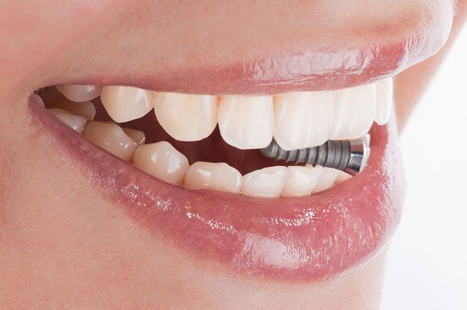 implantologia oral dental dentalquality certificado calidad