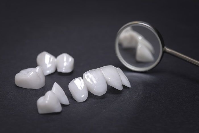 estetica dental carilla ceramica dentalquality