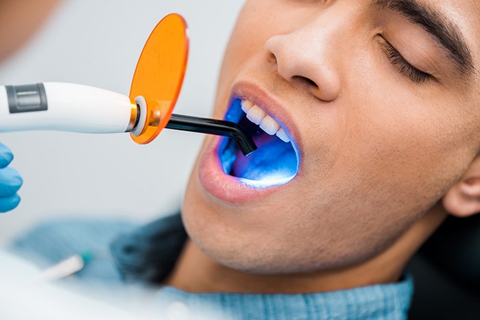 punch Chronic Unsatisfactory En qué consiste el blanqueamiento dental LED? | DentalQuality