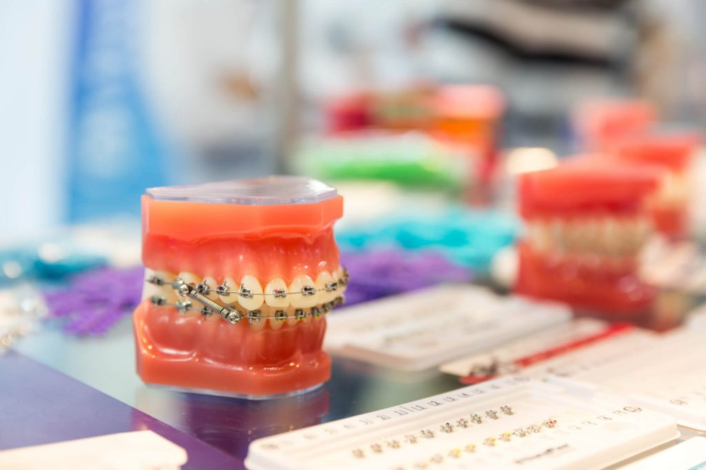 Por qué apostar por la ortodoncia low cost es peligroso para tu salud