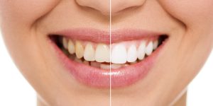 Cuánto Dura el Efecto de un Blanqueamiento Dental