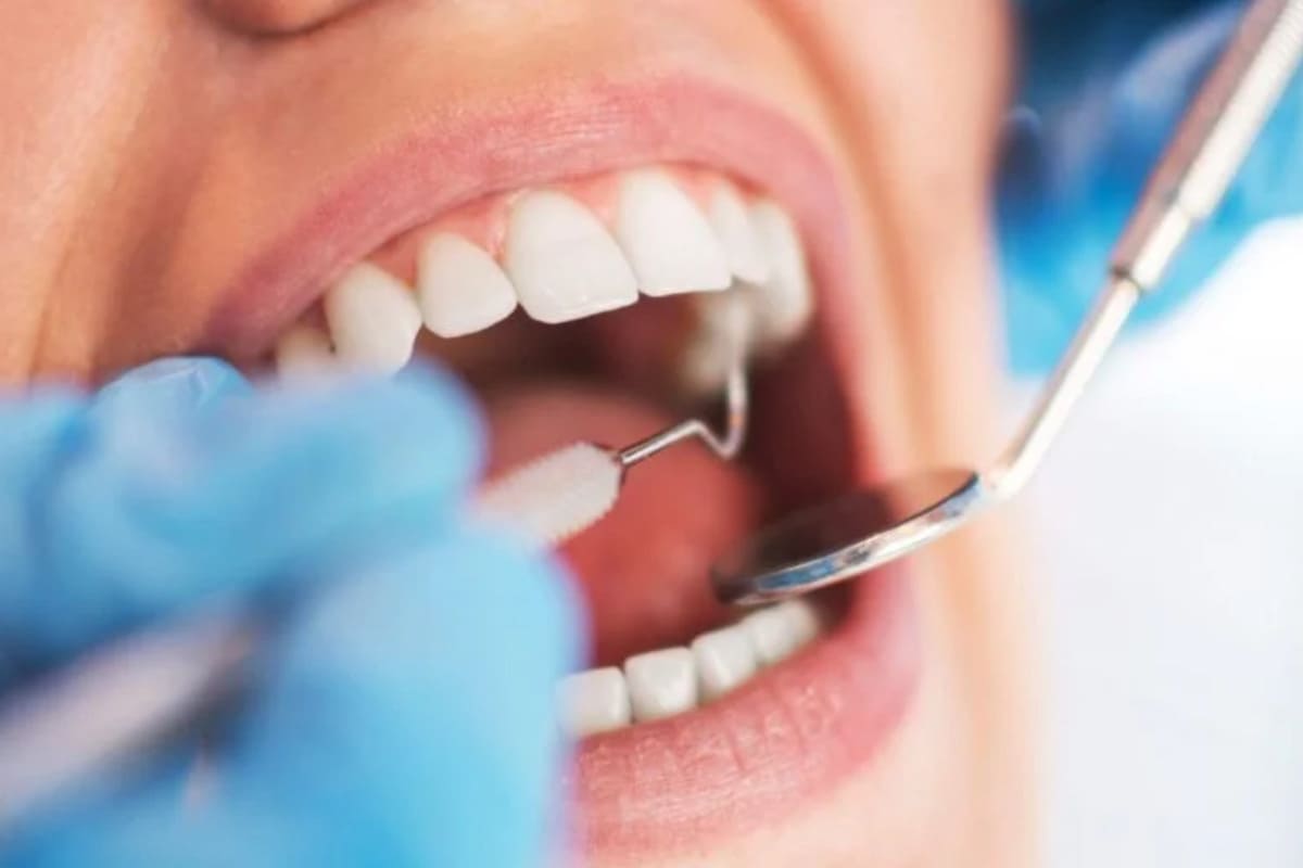 Consecuencias de la gingivitis