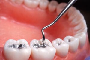 Empastes de plata (amalgama): ¿cuándo conviene cambiarlos?