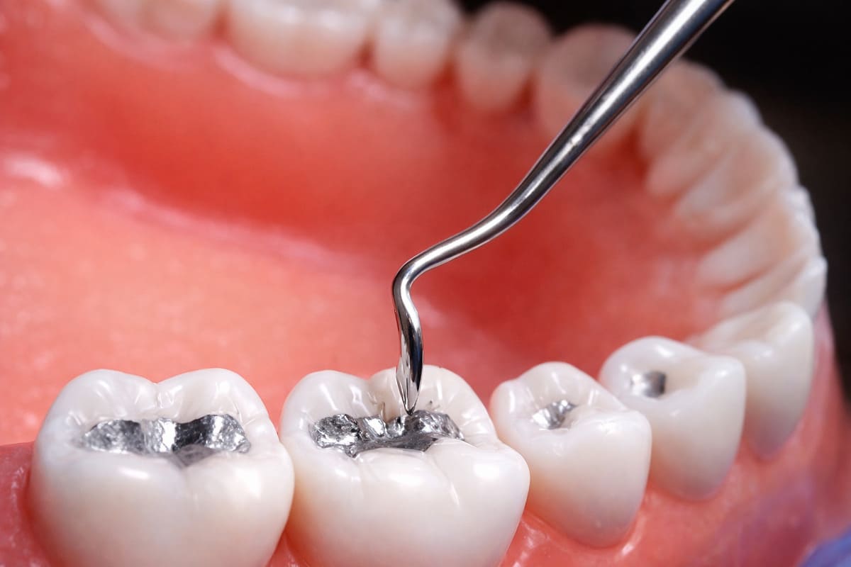 Empastes de plata (amalgama): ¿cuándo conviene cambiarlos?